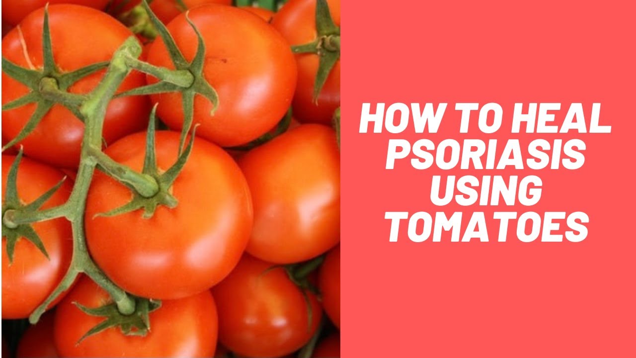 How to heal Psoriasis using Tomatoes. YouTube