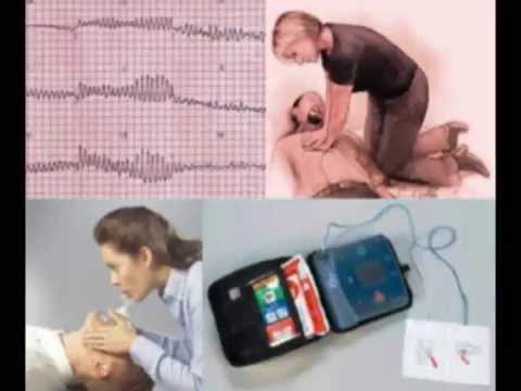 Cardiac Arrest -Part 1 : Definition and Causes (etiology)