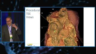 TEE vs  3D ICE for LAAO Procedural Guidance Strengths Weaknesses and How to Choose