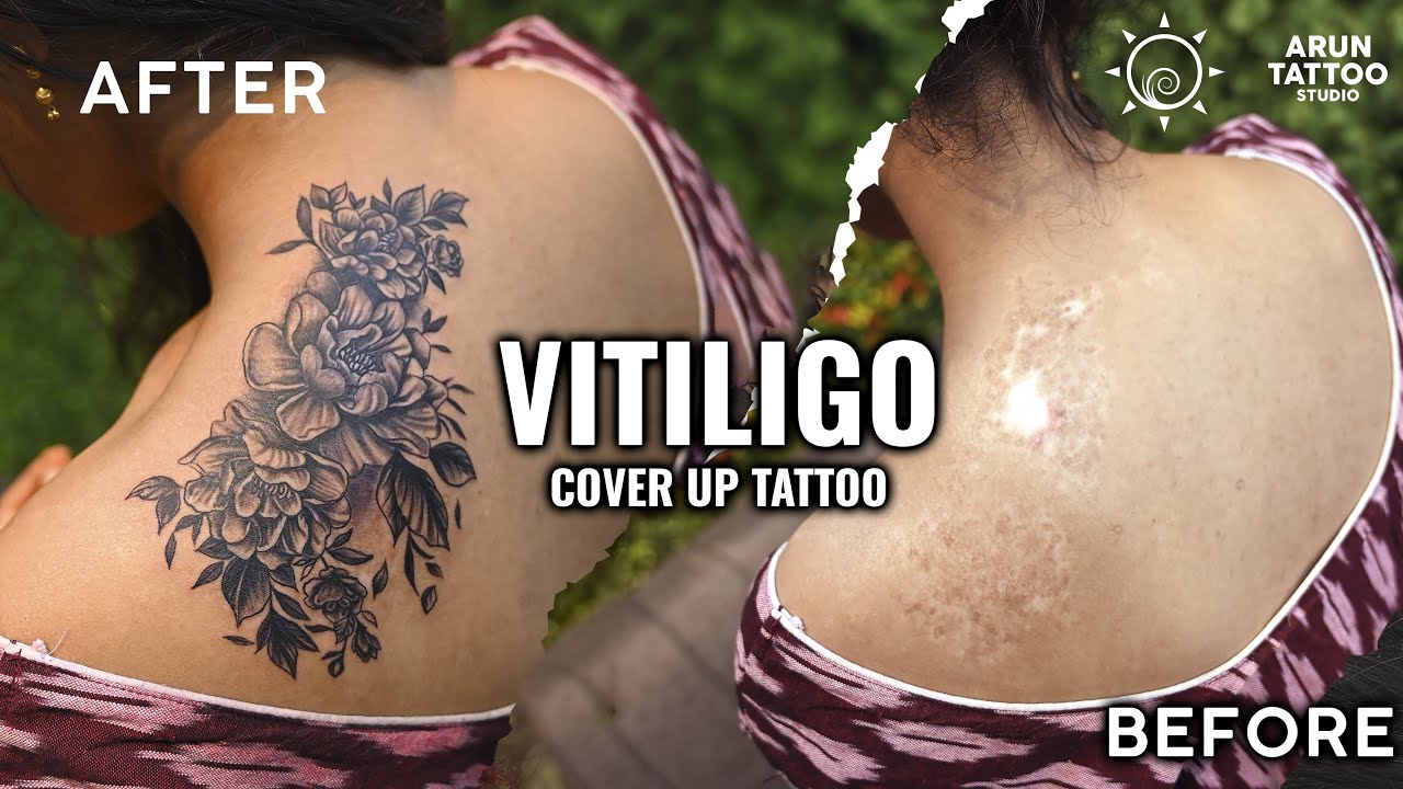 The Secret to Hiding Vitiligo : Life-Changing Coverup Tattoo