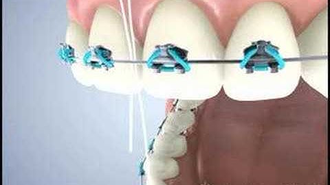 Floss Threaders By DenTek