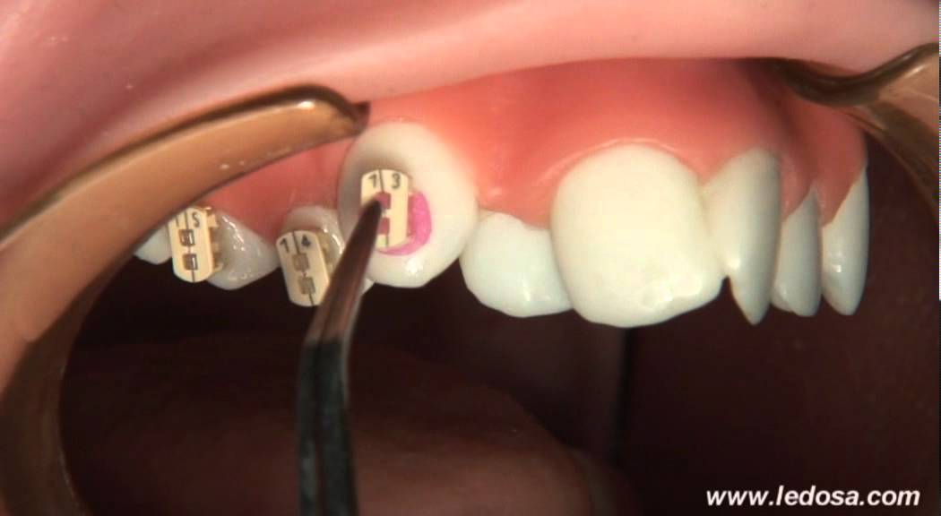 ORTOCERVERA / Ortodoncia Cementado de Brackets Autoligado Camaleón