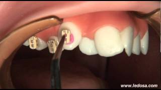 ORTOCERVERA / Ortodoncia: Cementado de Brackets Camaleón