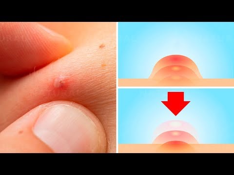 How To Get Rid of Pimples Fast at Home