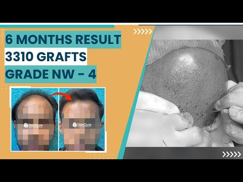 Hair Transplant Surgery: Modern Transplantation Techniques - video