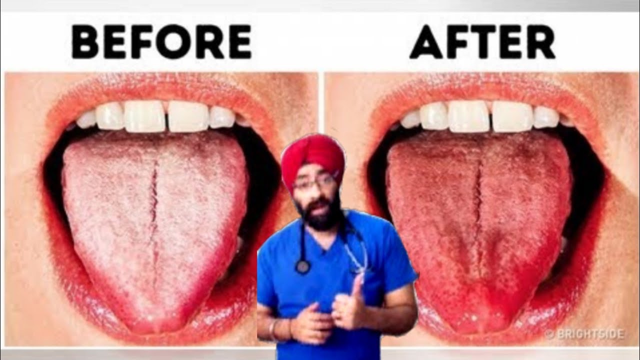 White Coated Tongue Remedy ORAL THRUSH CURE Dr.Education (ENG