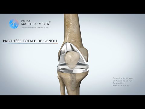 PROTHÈSE TOTALE DE GENOU - DR MATTHIEU MEYER