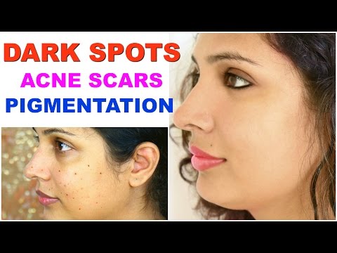 Dark Spots, Acne Marks, Pigmentation | Get Flawless Skin | ShrutiArjunAnand