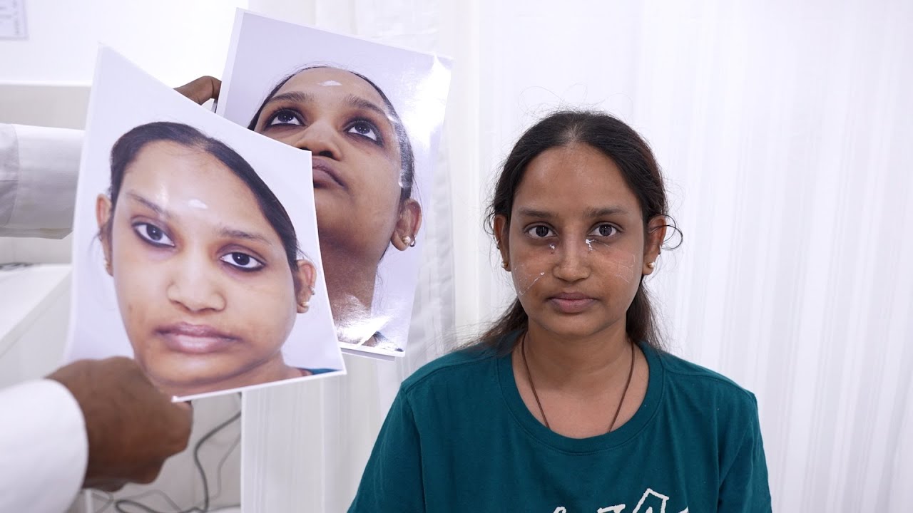 Nose Reconstruction Rhinoplasty for a Young Girl - YouTube