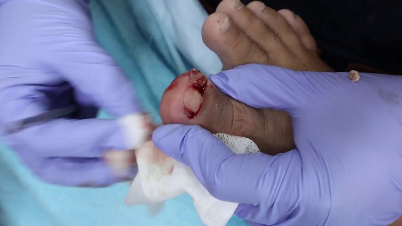 Ep_1596 Infected ingrown toenail removal ������ ทะลุ..สุด สุด 1 ������ (This clip is from Thailand) - YouTube