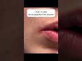 ЖЕЛЕЗОДЕФИЦИТНАЯ анемия