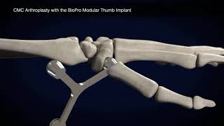 Thumb Surgery Animation with the BioPro Modular Thumb Implant