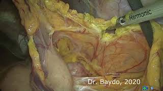 Laparoscopic spleen sparing distal pancreatectomy