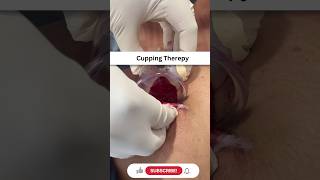 Cupping Therapy Treatment #chiropractic #yputubeshorts #shortsvideo