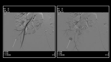 Inferior gluteal artery pseudoaneurysm embolization  with glue