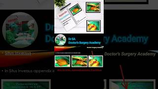 Situs Inversus Appendix | What is Situs Inversus | Appendix | #DrSA | #shorts | #youtubeshorts