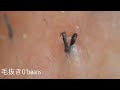毛掘りneo［Ingrown hair］12