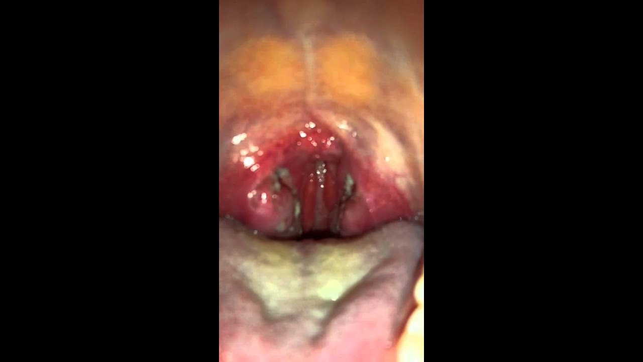 The Progression of strep throat - YouTube
