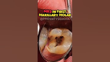 How To Find Mesiobuccal Canals (mb1,mb2,mb3): Access Opening iin maxillary first molar