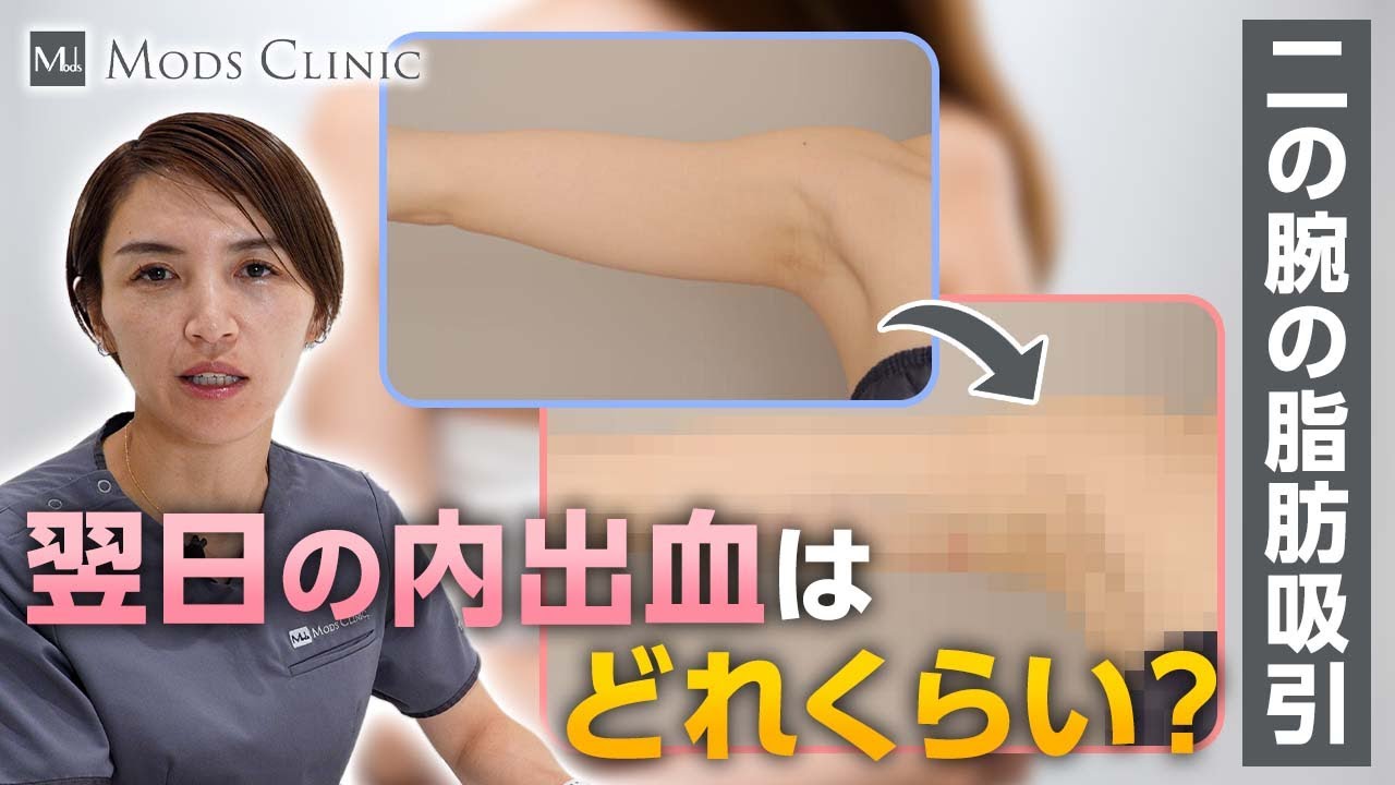 What is the downtime like the next day after upper arm liposuction