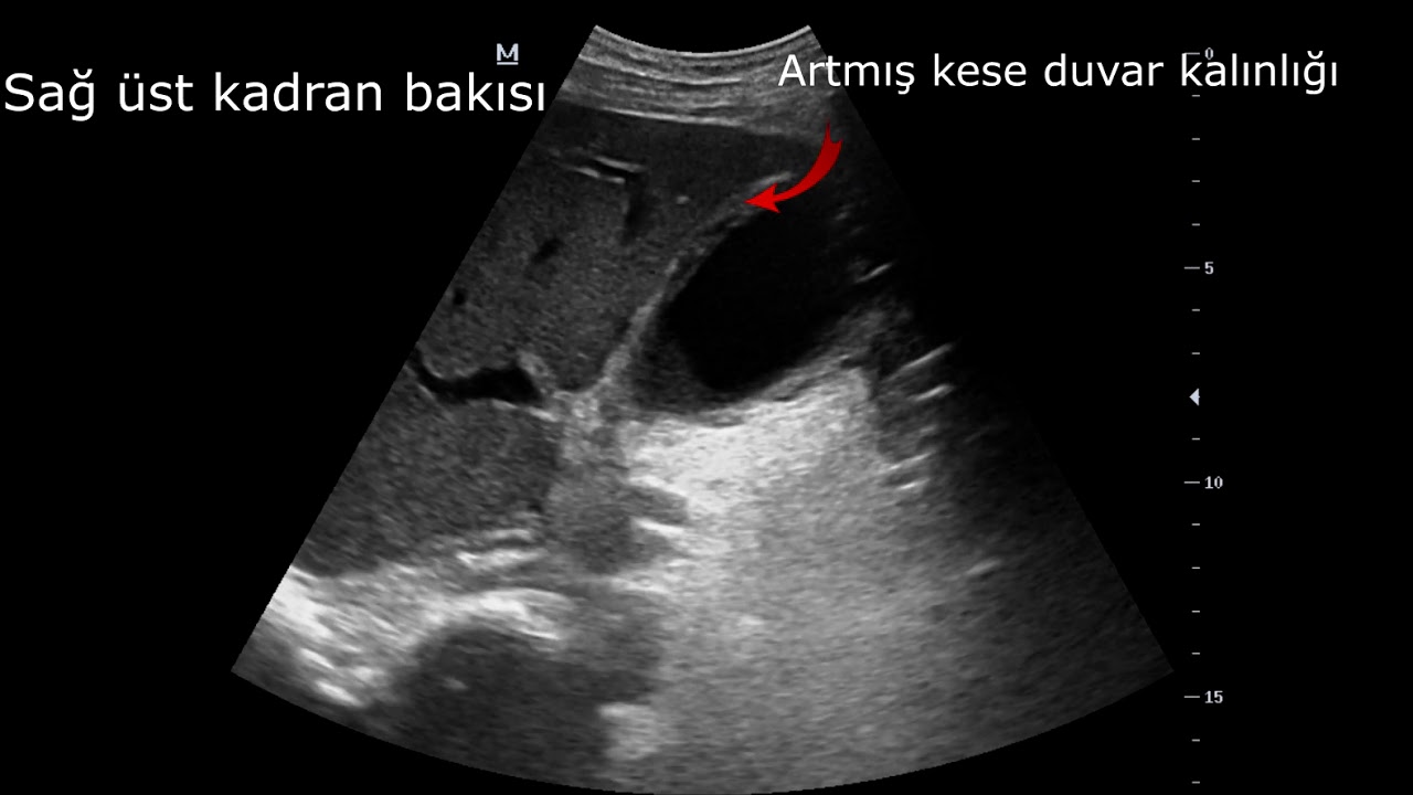 SAĞ ÜST KADRAN AĞRISINA  ACİL ULTRASONOGRAFİK YAKLAŞIM;  VAKA 2