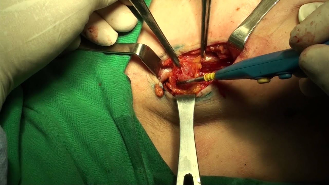 Operation 35 -  Complementary Excision for BrCa and SLNB