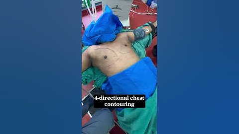 Grade 3A Gynecomastia Surgery | 360° 4Dx Chest Contouring On-Table Result