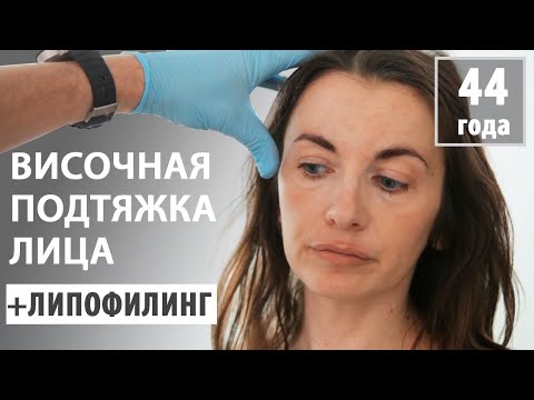 Подтяжка лица с липофилингом (пациентке 44 года)