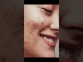 Acne Ka Asaan Ilaj 😱 | Pimples Remove Karne Ka Best Tarika (Fast Result Guide) #PimplesRemoval