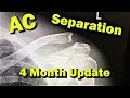 AC Joint Separation Recovery. Long-term progress update