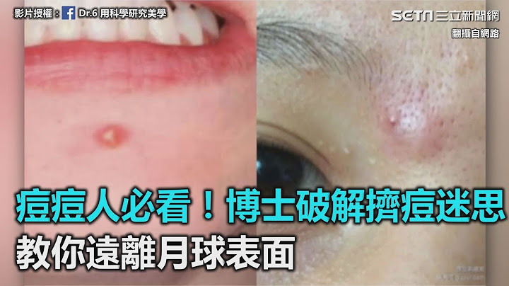 痘痘人必看！博士破解擠痘迷思　教你如何遠離月球表面｜三立新聞網SETN.com - 天天要聞
