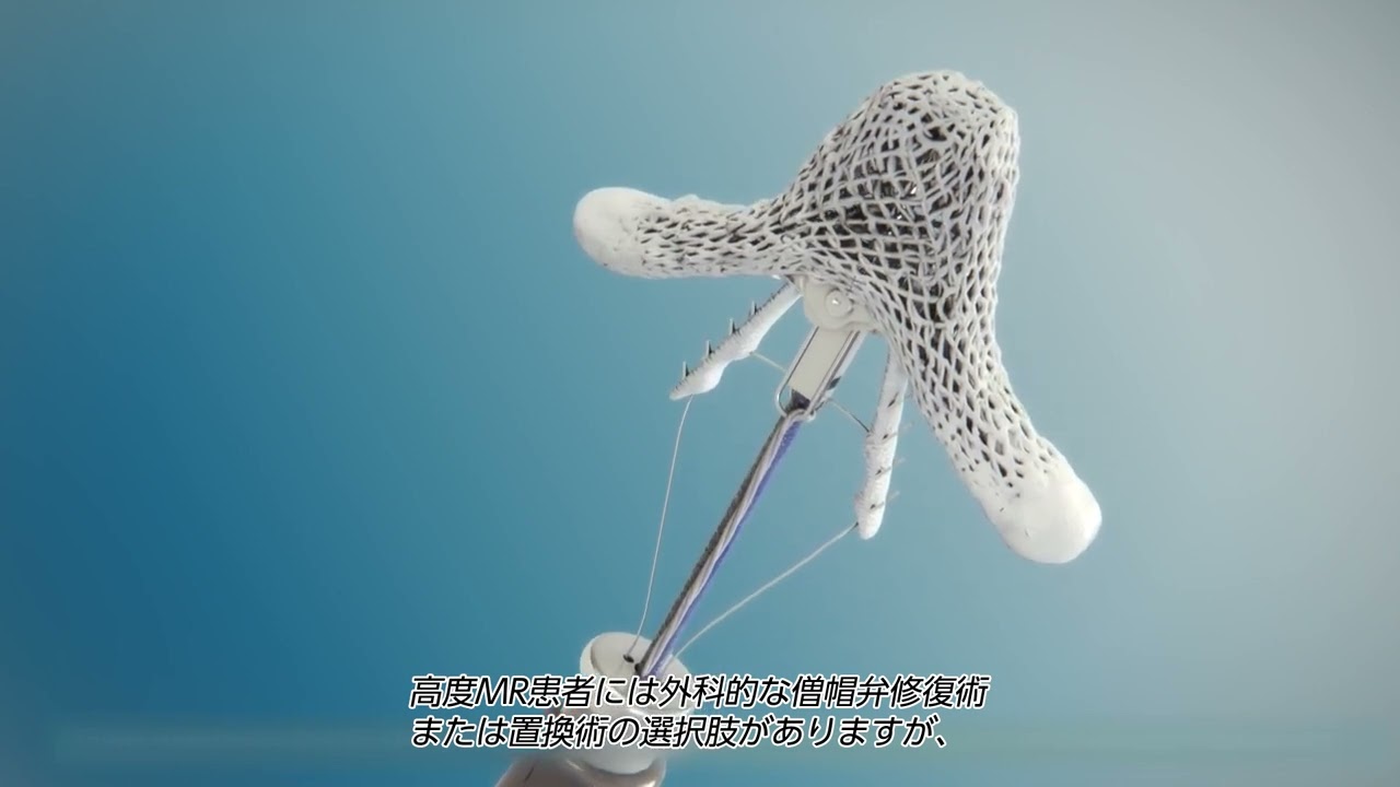 Percutaneous mitral valve repair (Provided by Abbott Medical Japan