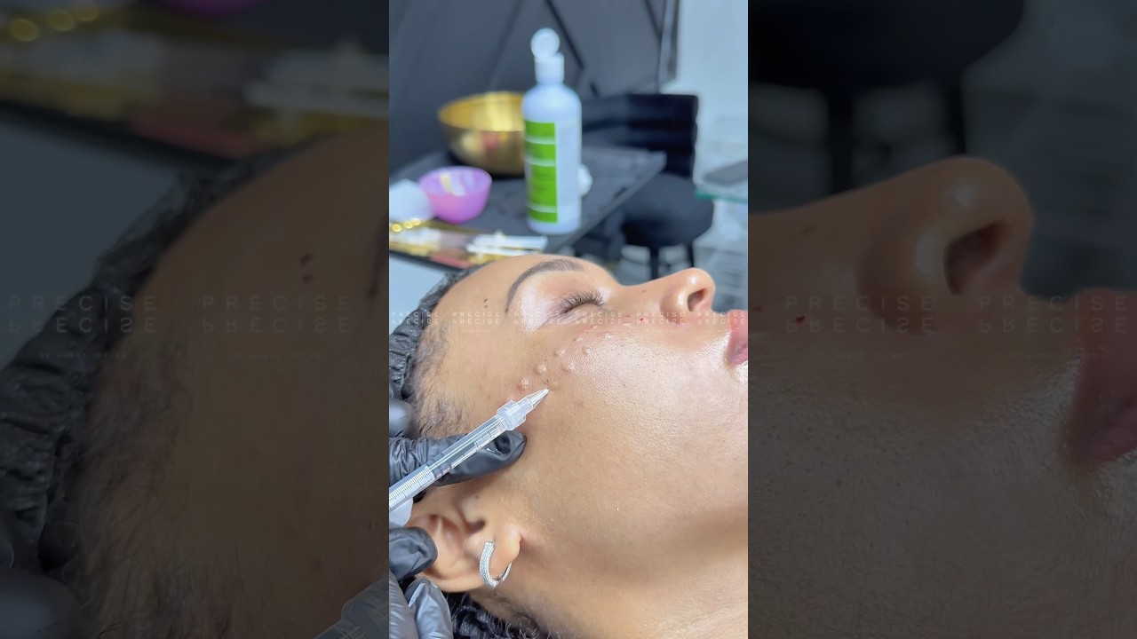 MESO therapy with Peptides and Exosome , meso injections #mesotherapy #mesoexosome