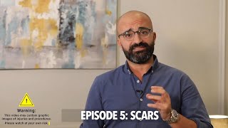 Episode 5: Scar Treatment | الحلقه الخامسة: علاج اثار الجروح و الندبات screenshot 3