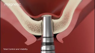 Sinus Lift using the Magnetic Mallet