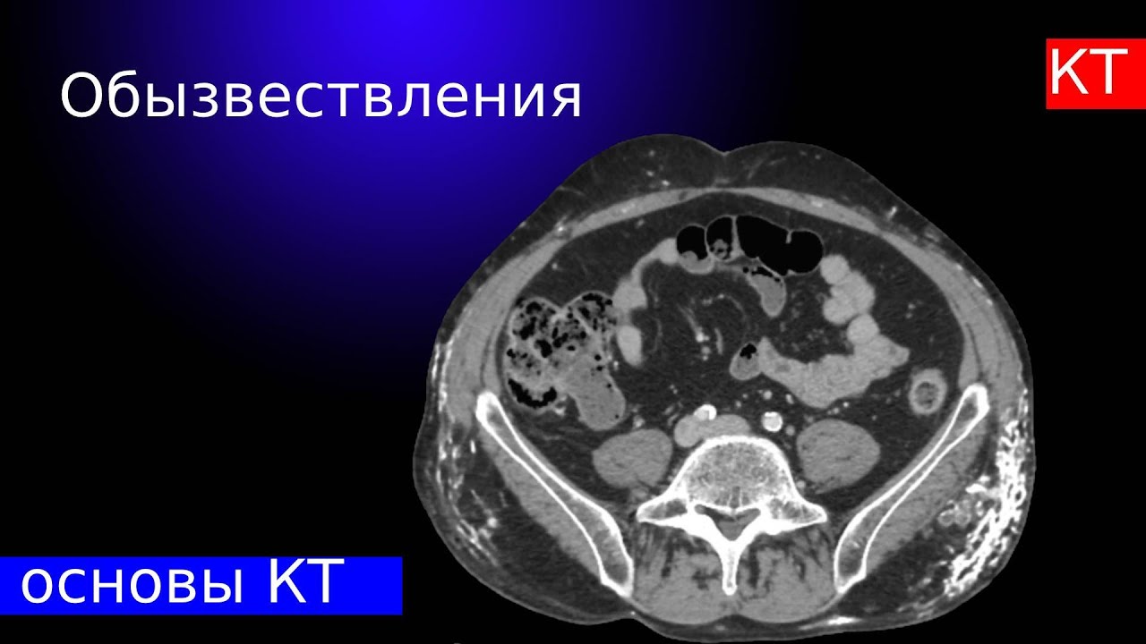 Кальцинаты селезенки