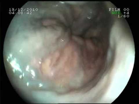 esophageal varices with fundal extensions PART 1 ....