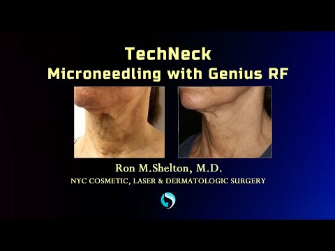 TechNeck Microneedling RF