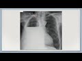 Derrame pleural