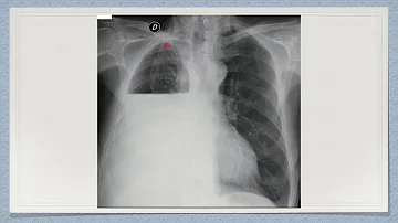 ¿Cuánto tiempo se puede vivir con un derrame pleural no maligno?