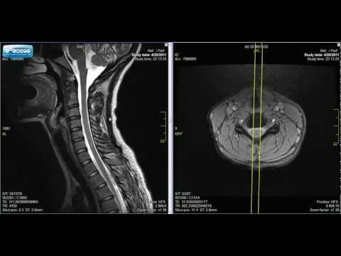Normal Cervical Spine MRI Explained | Dr. Jeffrey P.Johnson | HD
