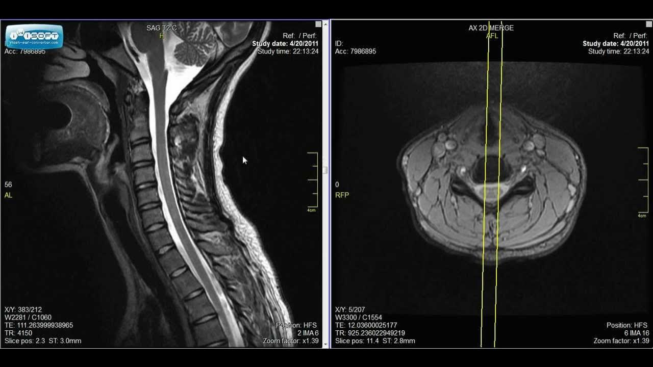 Normal cervical spine mri explained dr jeffrey p johnson hd youtube