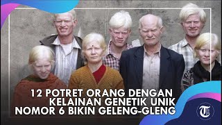 12 Potret Orang dengan Kelainan Genetik Unik, Nomor 6 Bikin Geleng Geleng