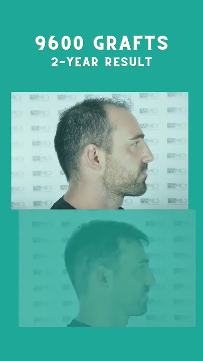 After having two hair transplant surgeries at ASMED, here is how our patient Brice looks like. 😍