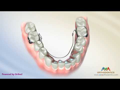 Orthodontic Expander or