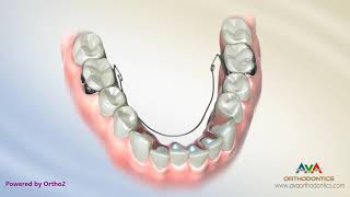 Orthodontic Expander or Spacer - Lower BiHelix Appliance