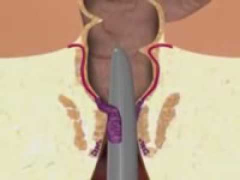 Video: Uklanjanje Hemoroida: Kirurškim Zahvatom I Bez Operacije