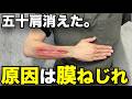 五十肩が消えた。膜のねじれを治すだけ。