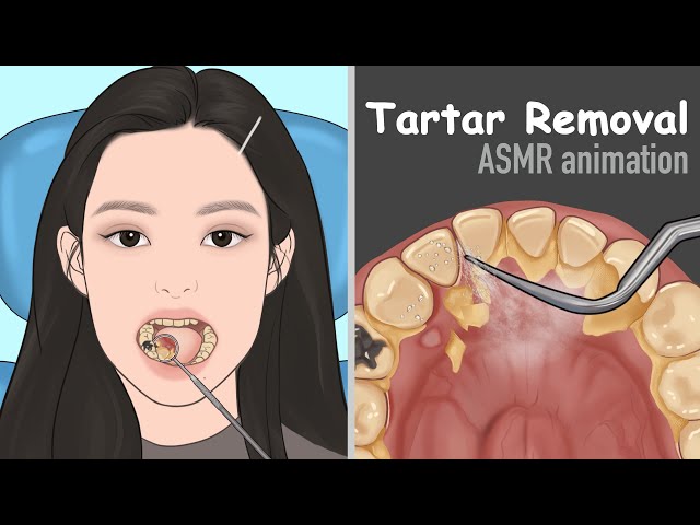 [ASMR] Tartar removal animation / Dental Scaling / Satisfying class=