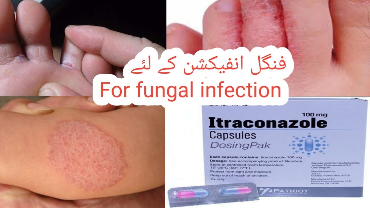 Itraconazole Uses Side Effects And Warning Full Review YouTube Itraconazole Uses Side Effects And Warning Full Review YouTube